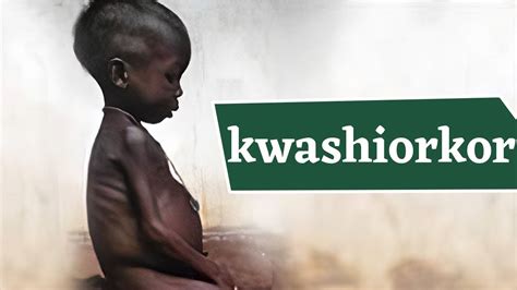 Kwashiorkor Disease What Causes Kwashiorkor जानिये क्वाशियोरकर रोग