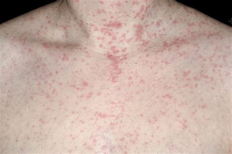 Allergic Reaction To Amoxicillin Stock Image C0532253 Science