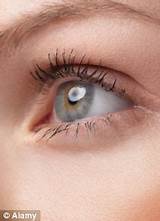 What Is Lasik Eye Surgery Cost In India Images