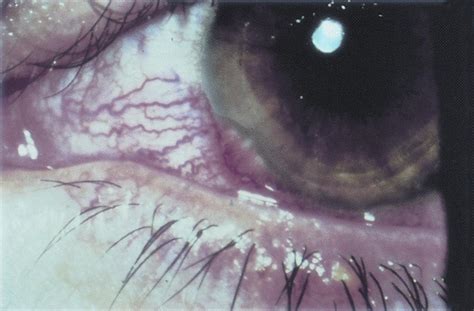 Confluent Phlyctenules Secondary To Staphylococcal Blepharitis