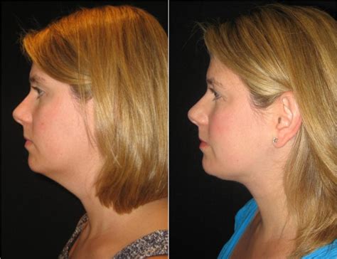 Neck Lift Before And After Fairfax And Washington Dc