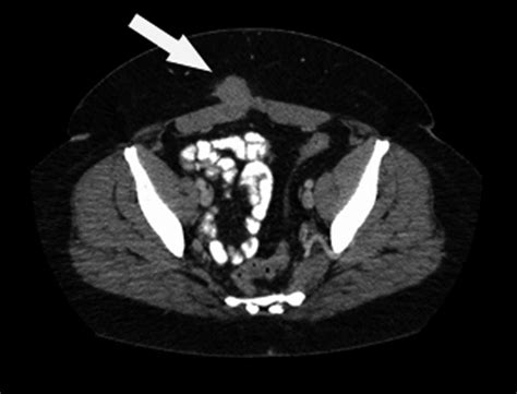 Ct Of The Abdomen Reveals A Mass Suggestive Of A Ventral Hernia