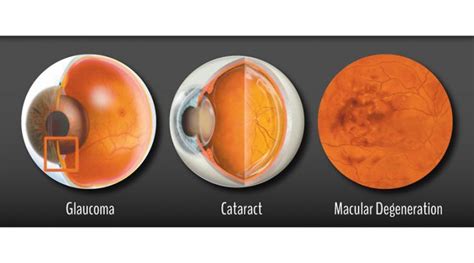Cataract Cataract Surgery Cataracts To Macular Degeneration