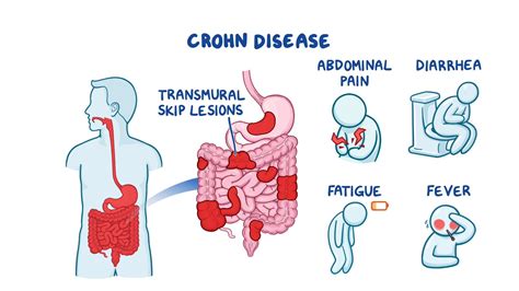 Inflammatory Bowel Disease Crohn Disease Clinical Sciences Osmosis Video Library