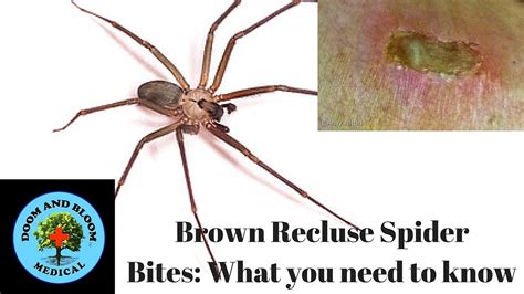 Can You Feel A Brown Recluse Spider Bite 4 Things To Know About Brown