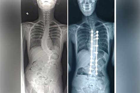 Spinal Fusion Surgery During Covid 19 Boston Childrens Answers