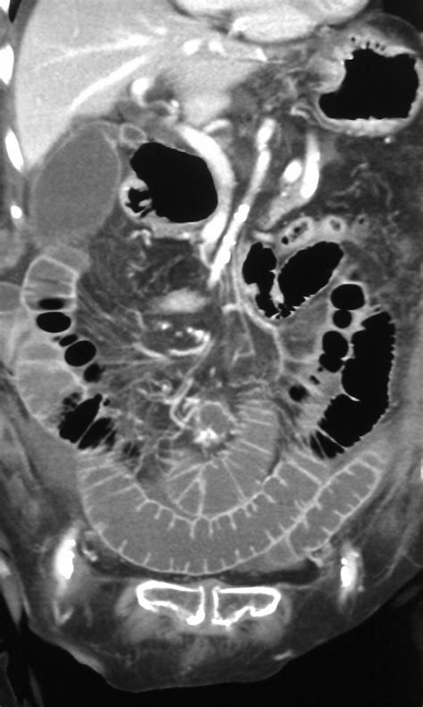 Learning Abdominal Radiology Case 205 Internal Hernia