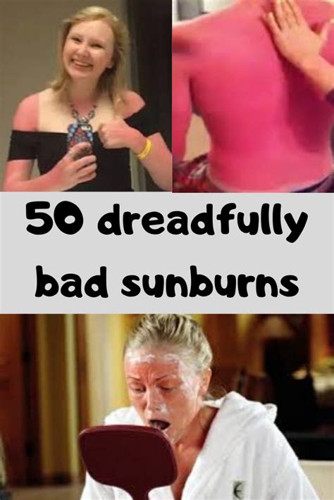 50 Dreadfully Bad Sunburns Artofit