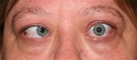 Strabismus Causes Symptoms Diagnosis Strabismus Treatment And Surgery