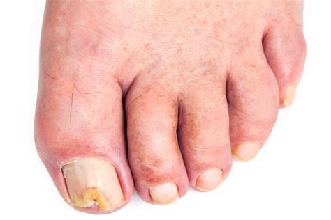 Toenail Fungus Pictures Symptoms Causes Treatment