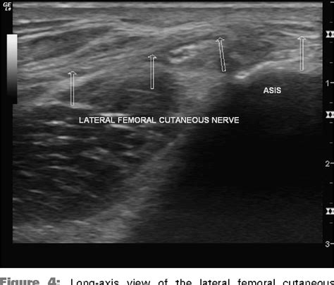 Figure 3 From Ultrasound Guided Percutaneous Neuroplasty Of The Lateral