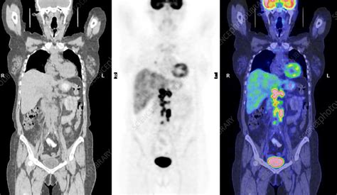 Non Hodgkins Lymphoma Ct And Pet Scans Stock Image M1340688
