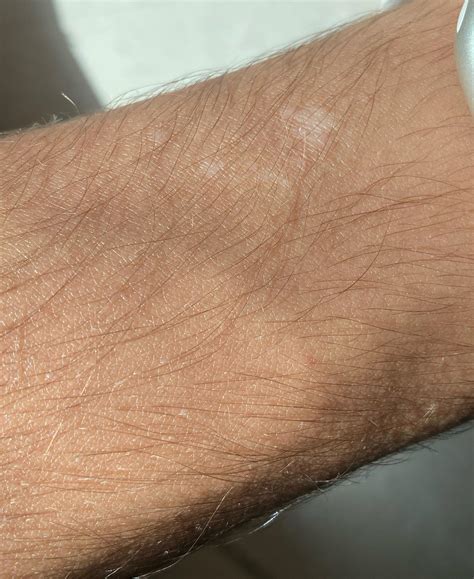 White Spots On My Skin Is This Naturally Occurring Rmedical