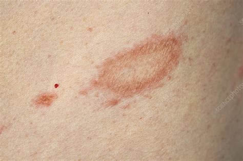 Papulosquamous eruption of pityriasis rosea. Herald patch in pityriasis rosea - Stock Image - C046/3451 ...