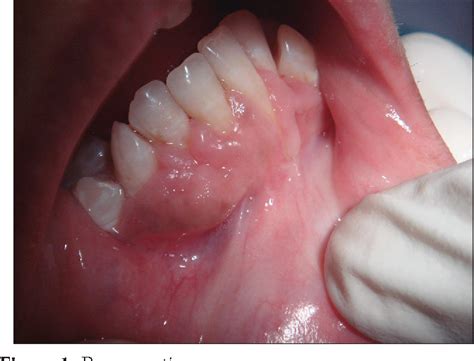 Figure 2 From Mandibular Exostosis In Canine With Single Tooth