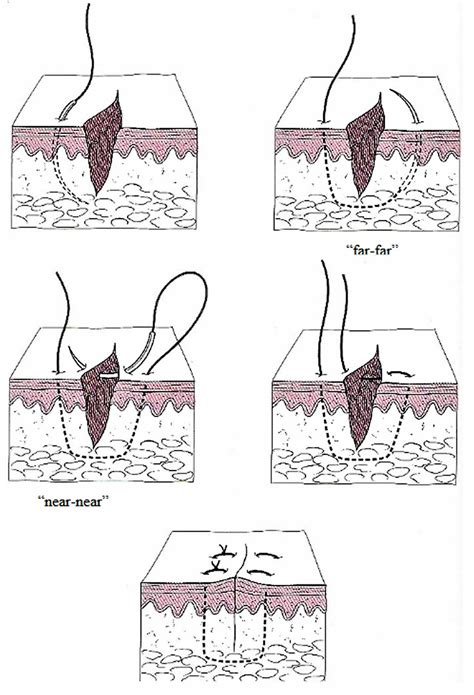 Surgical Suture Types Of Sutures Sizes How To Suture And Suture