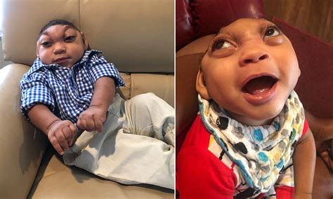Baby Born With Part Of His BRAIN Sticking Out From His Skull Defies Slim Chance Of Survival