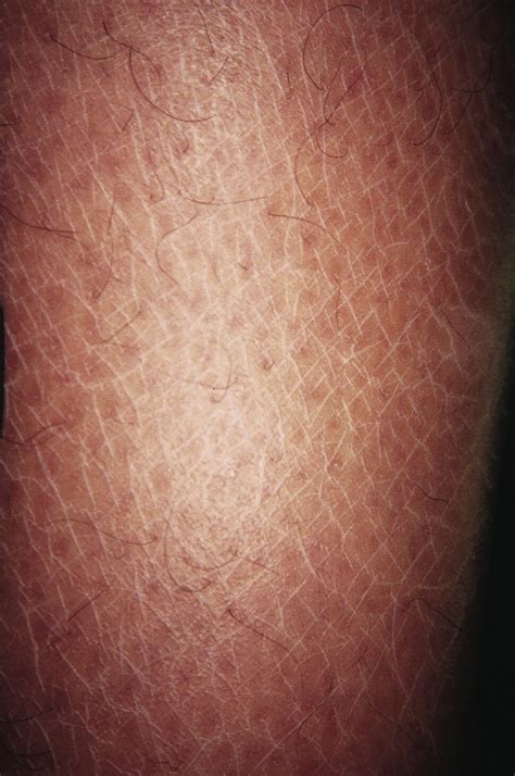 How To Detect And Treat Pruritus