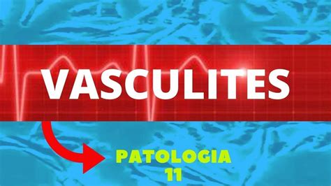 Vasculites Entenda A Vasculite E Seus Tipos Patologia 11 Youtube