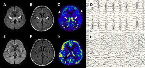 Brain Magnetic Resonance Imaging And Electroencephalography Findings Of Download Scientific