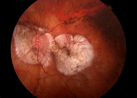 Deep Learning Models Can Identify Myopic Maculopathy Ophthalmology