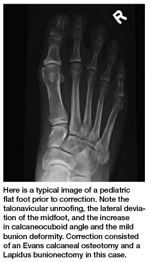 Considering The Power Of Pediatric Flexible Flatfoot Procedures Podiatry Today
