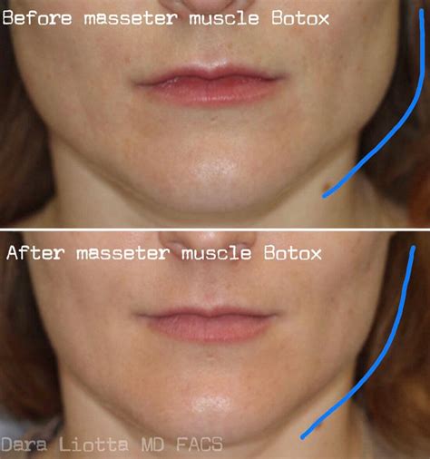 Mothlhtqqjbpqdp Botox In Masseters Before And After