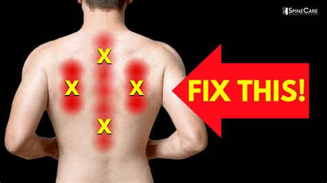 How To Instantly Relieve Nerve Pain In Your Upper Back Spinecare