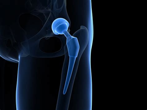 The Different Types Of Hip Replacement Your Options Saga