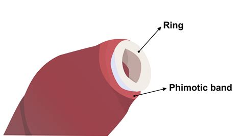 Phimosis Stretching Rings Kit For Tight Foreskin Treatment Phimostretch