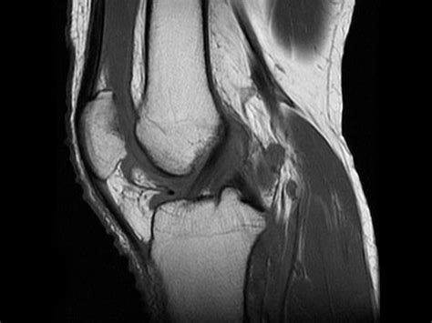 Osteoarthritis Knee Mri