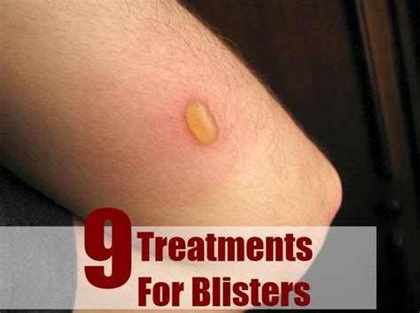 Treatment For Blisters On Pinterest