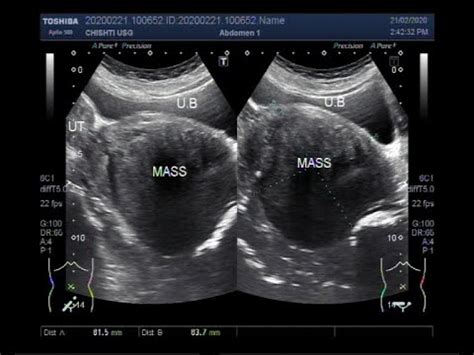 Ultrasound Video Showing A Large Cervical Mass YouTube