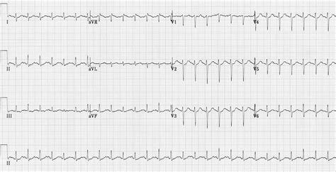 Sinus Tachycardia Litfl Ecg Library Diagnosis