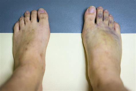 Swollen Feet And Ankles After Covid Vaccine