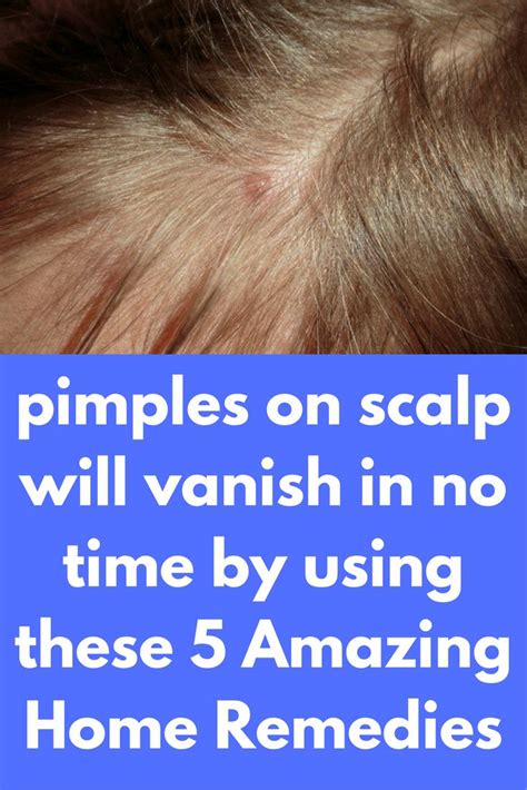 Pimples On Scalp Will Vanish In No Time By Using These 5 Amazing Home