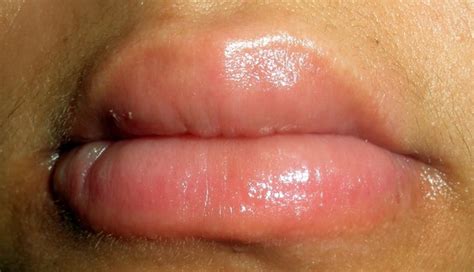 Swollen Lips Causes Treatment Pictures Remedies