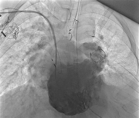 Implanted Pacemaker And Cardioverter Defibrillator In A Patient With