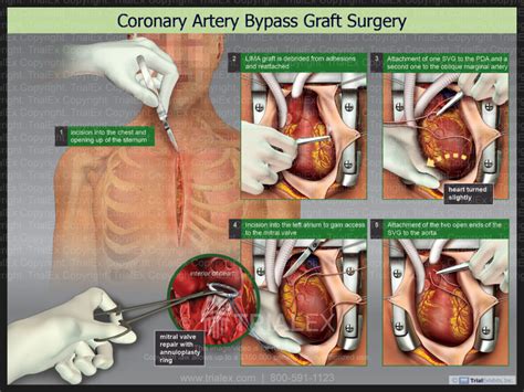 Coronary Artery Bypass Graft Surgry Trial Exhibits Inc