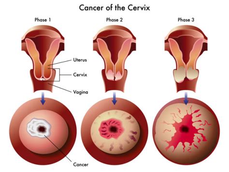 Cervical Cancer Symptoms And Signs Cervical Cancer Prevention
