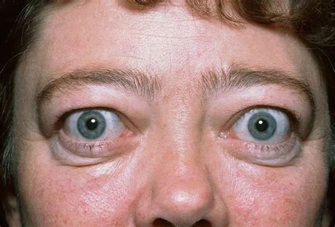 Graves Disease Picture Image On