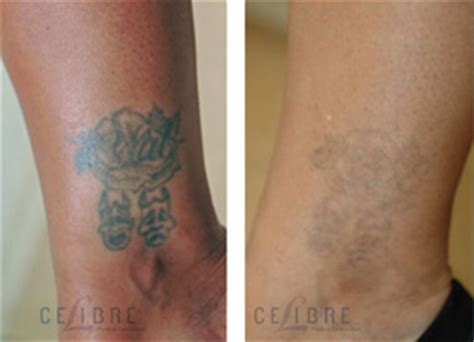 I also can tell you the procedure is very costly. What will My Laser Tattoo Removal Cost?