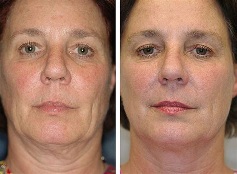 Face Workouts To Gain A Diy Natural Facelift Can Face