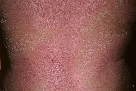 Erythrodermic Psoriasis Pictures Symptoms And Pictures