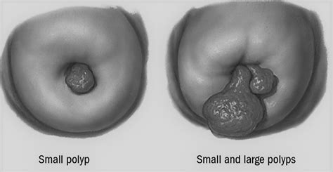 Cervical Polyps What You Should Know The Physiologist Perspective
