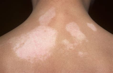 Thyroid Cancer Rash Papillary Thyroid Cancer Is The Most Common Type