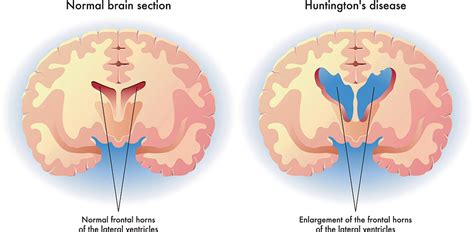 Huntingtons Disease What Its Like To Face The Threat Of Huntington