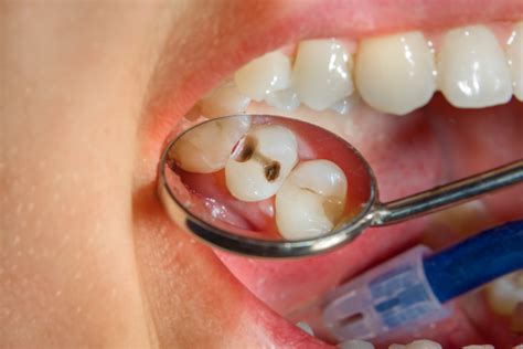 What Is Dental Caries Treatments Signs And Symptoms Keith A