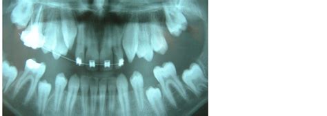 Extraction Timing Of Heavily Destructed Upper First Permanent Molars