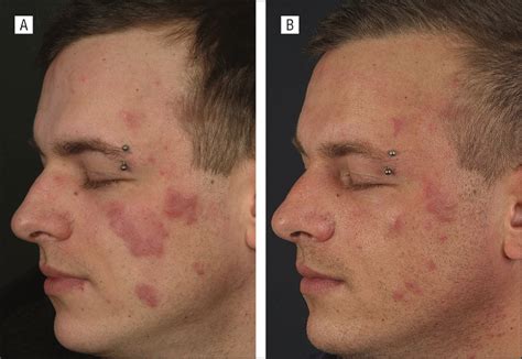 Lupus Erythematosus Tumidus Response To Antimalarial Treatment In 36 Patients With Emphasis On